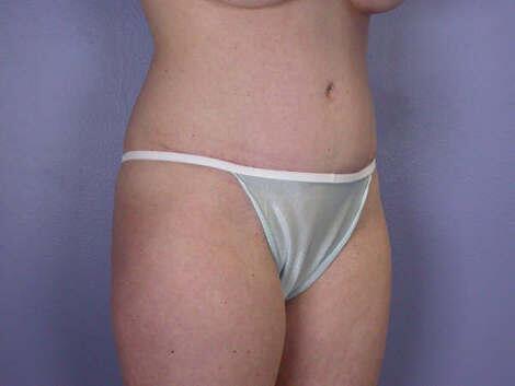 Liposuction Before & After Image