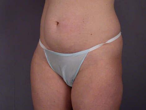 Liposuction Before & After Image