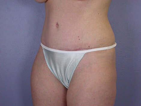 Liposuction Before & After Image