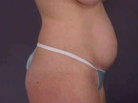 Liposuction Before & After Image