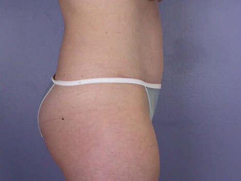 Liposuction Before & After Image