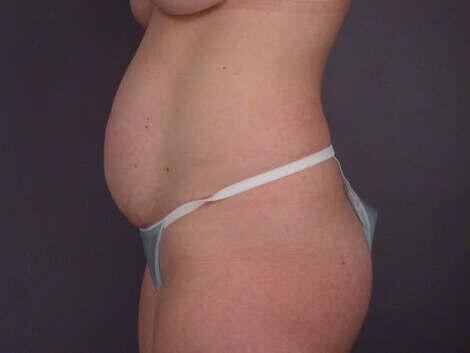 Liposuction Before & After Image