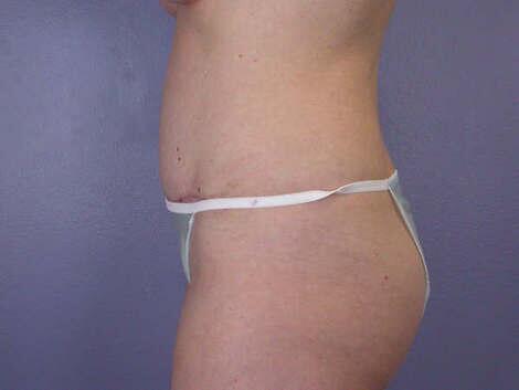 Liposuction Before & After Image