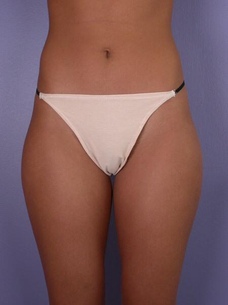 Liposuction Before & After Image