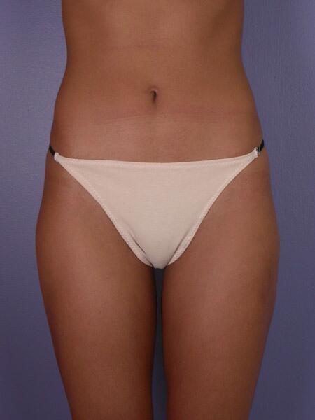 Liposuction Before & After Image