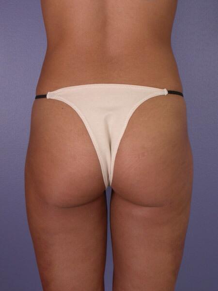 Liposuction Before & After Image