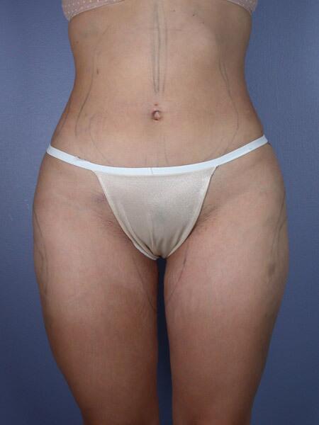 Liposuction Before & After Image