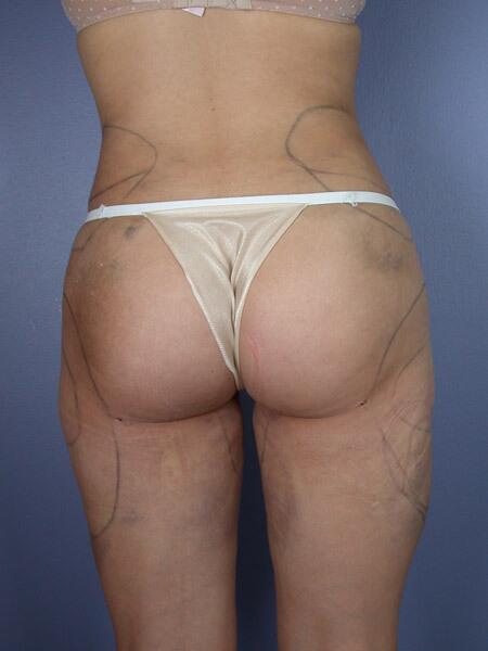 Liposuction Before & After Image