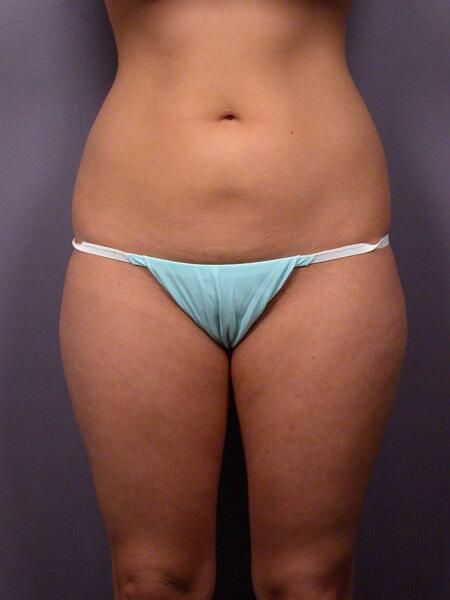 Liposuction Before & After Image