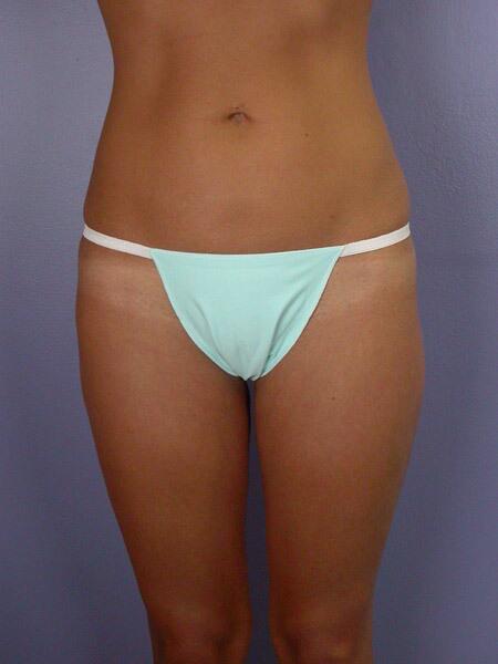 Liposuction Before & After Image