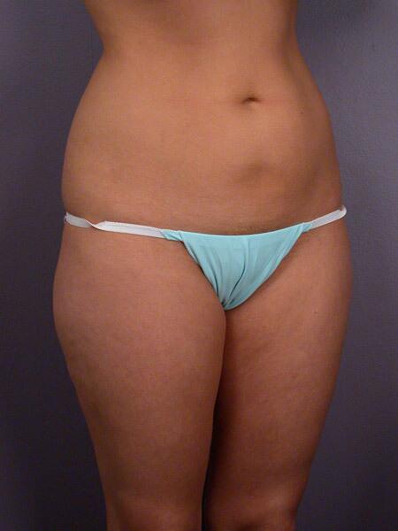 Liposuction Before & After Image