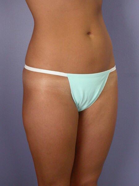 Liposuction Before & After Image