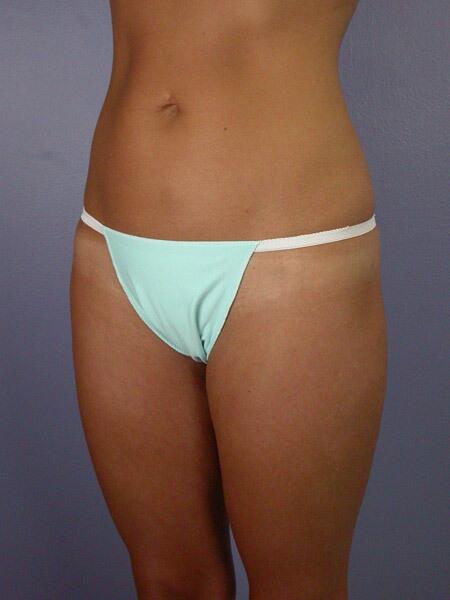 Liposuction Before & After Image