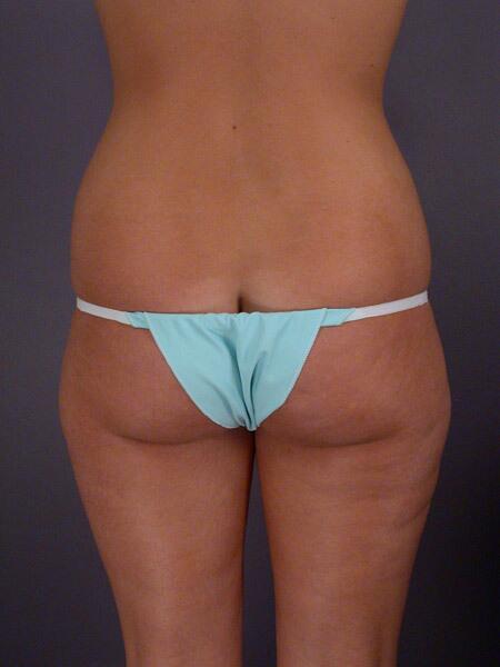 Liposuction Before & After Image