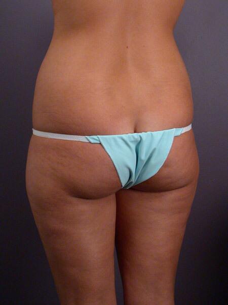 Liposuction Before & After Image