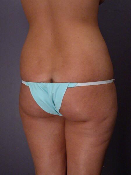 Liposuction Before & After Image