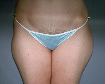 Liposuction Before & After Image