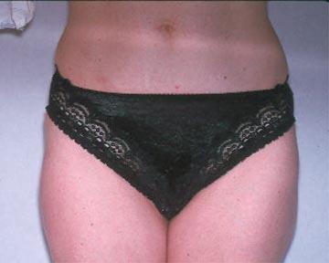 Liposuction Before & After Image