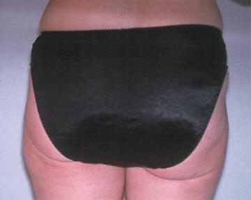 Liposuction Before & After Image