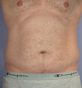 Liposuction Before & After Image