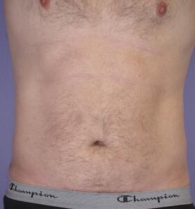 Liposuction Before & After Image