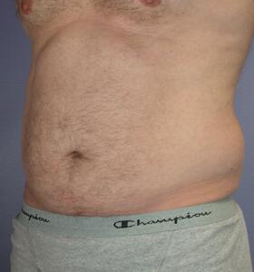 Liposuction Before & After Image