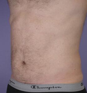 Liposuction Before & After Image