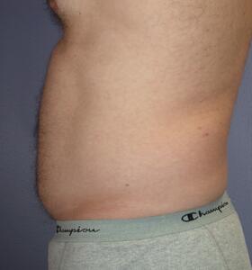 Liposuction Before & After Image