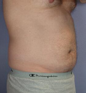 Liposuction Before & After Image