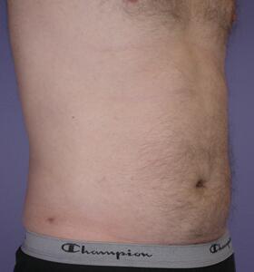 Liposuction Before & After Image