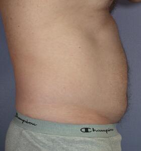 Liposuction Before & After Image