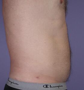 Liposuction Before & After Image