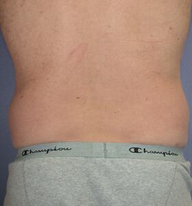 Liposuction Before & After Image