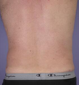 Liposuction Before & After Image