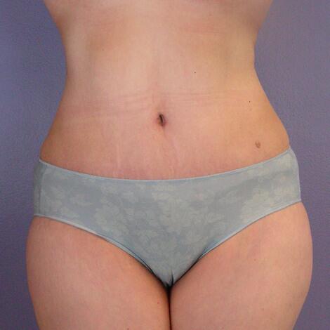 Liposuction Before & After Image