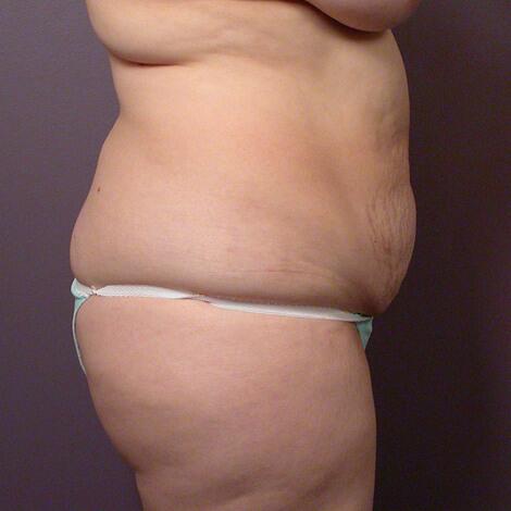 Liposuction Before & After Image