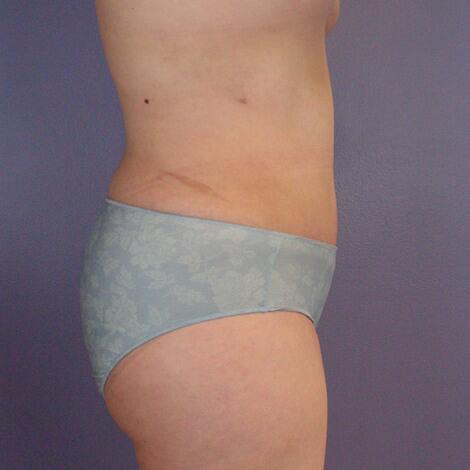 Liposuction Before & After Image