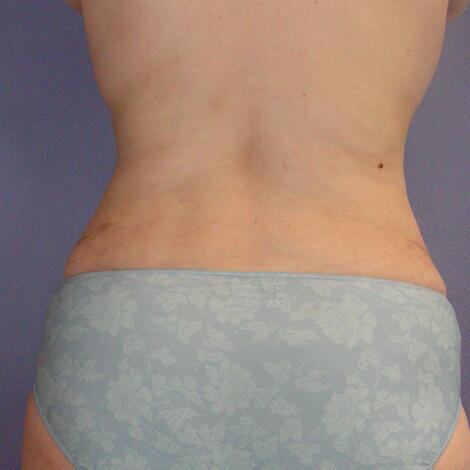 Liposuction Before & After Image