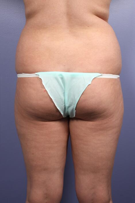 Liposuction Before & After Image