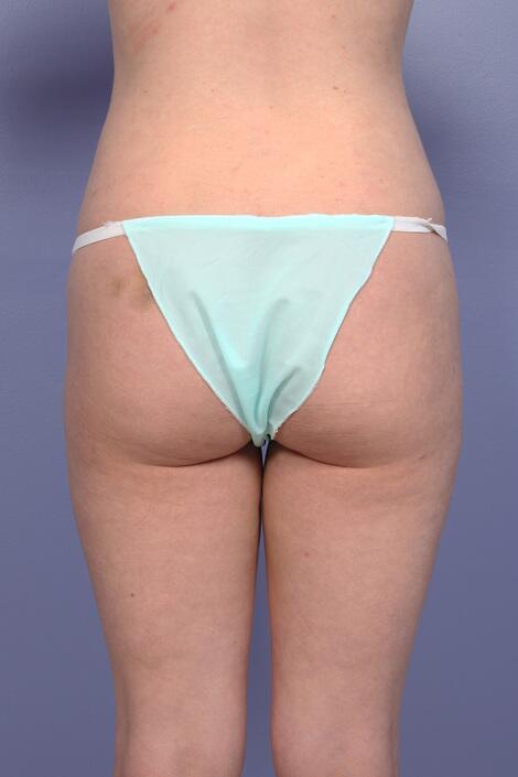 Liposuction Before & After Image