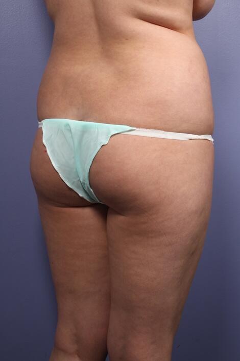 Liposuction Before & After Image