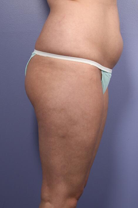 Liposuction Before & After Image