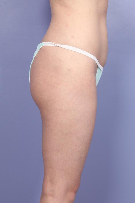 Liposuction Before & After Image