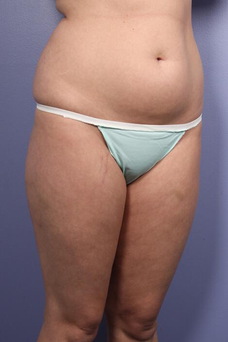 Liposuction Before & After Image