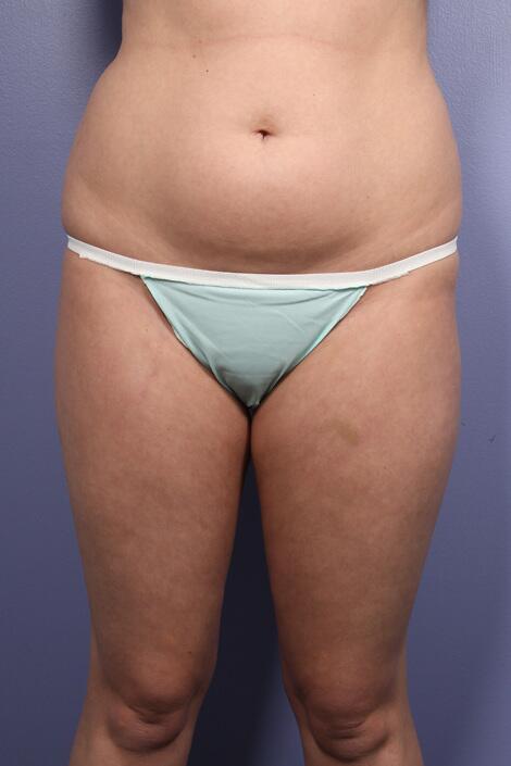 Liposuction Before & After Image