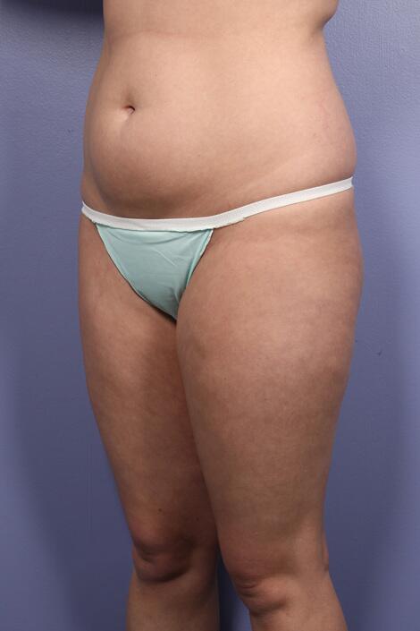 Liposuction Before & After Image