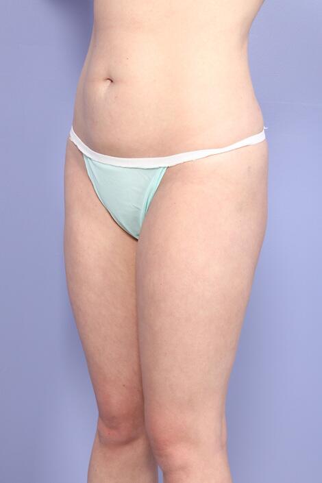 Liposuction Before & After Image