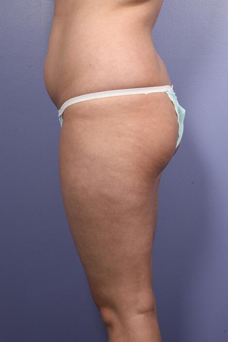 Liposuction Before & After Image