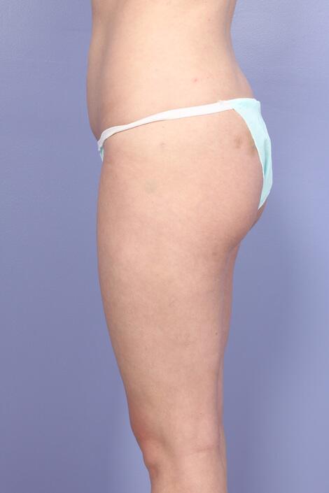 Liposuction Before & After Image