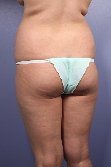 Liposuction Before & After Image